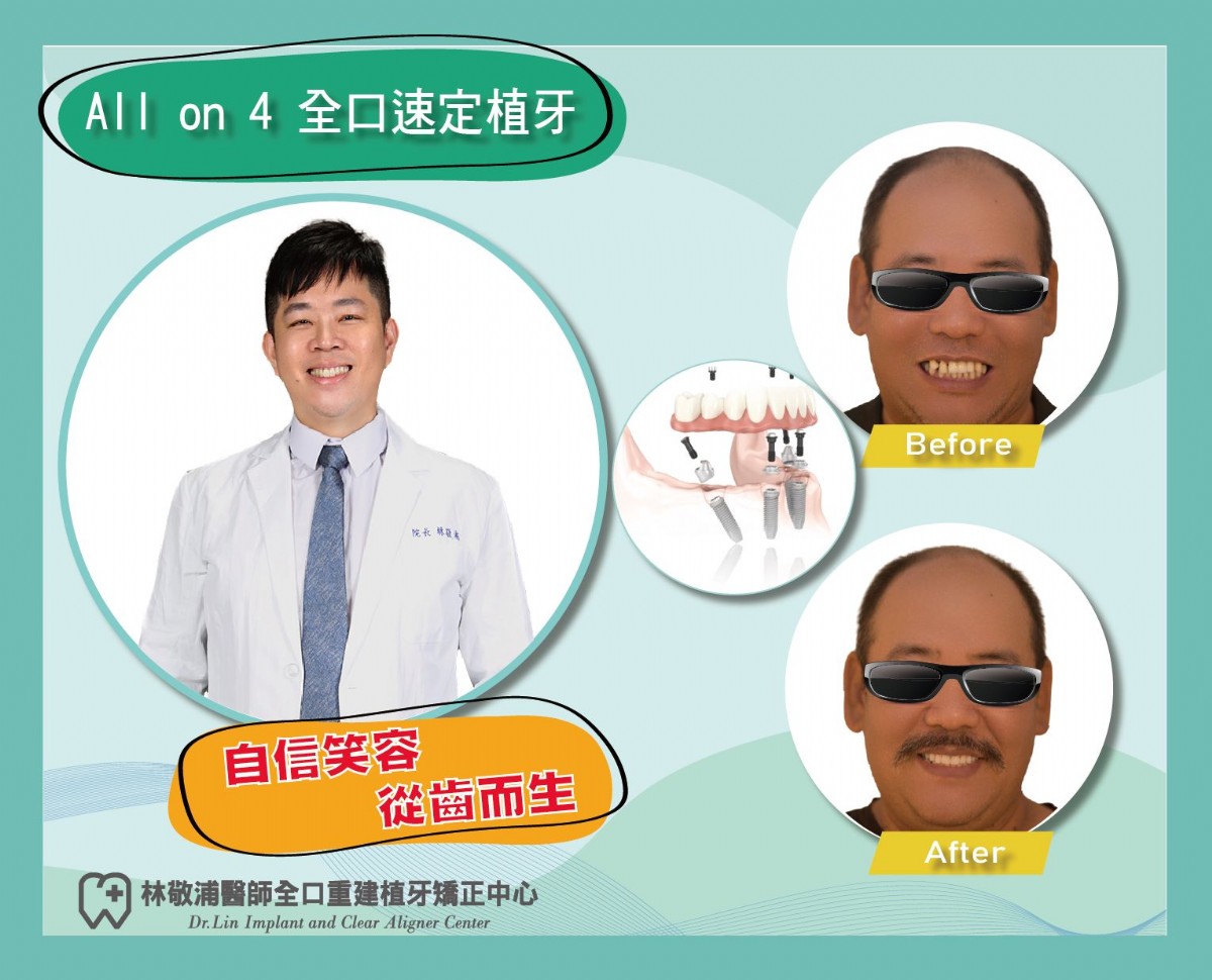 all on 4 全口重建