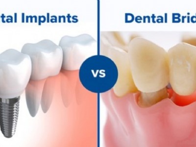 植牙和牙橋，哪個對患者較好